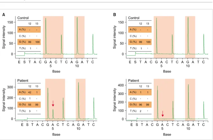 Fig. 2. K-ras mutation by pyrosequencing. Pyrogram shows the mutation and mutated clones