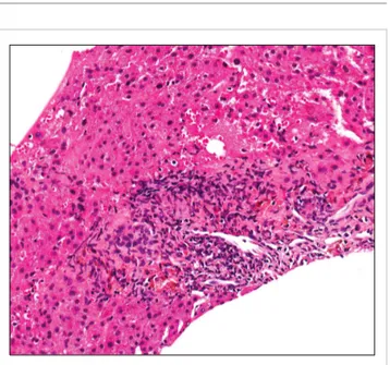 Fig. 1. Liver biopsy reveals mild biliary epithelial damage of portal tract,  lymphocytic infiltraion and mild peacemeal necrosis.