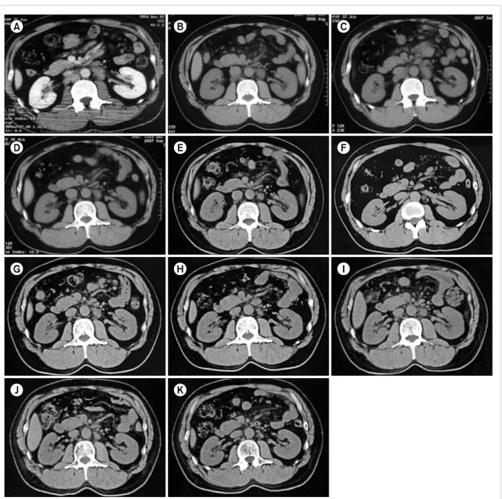 Fig. 1. Computed tomography. (A) Contrast-enhanced abdominal computed tomography (CT) image showing para-aortic lymphadenopathy at the time of admission