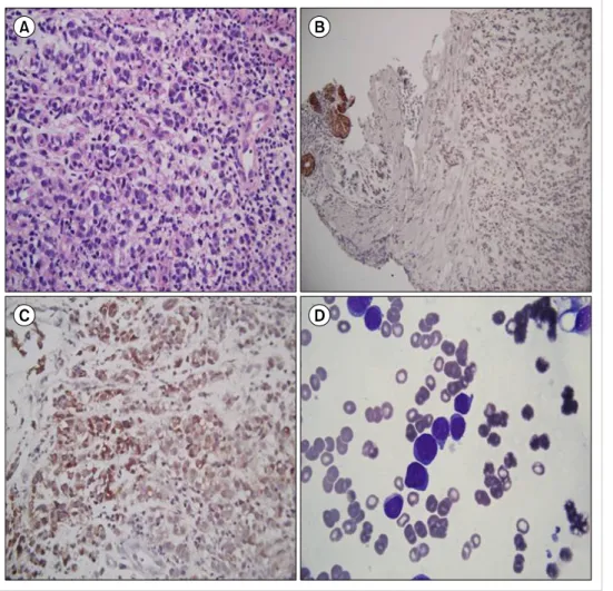Fig. 3. (A) Poorly differentiated mali- mali-gnant-cell infiltrates with epithelioid features in the myxoid stroma