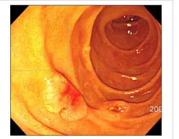 Fig. 1. Endoscopic findings of the duodenal mucosal lesion. Fig. 2. Infiltrating cells were immunoreactive for CD34