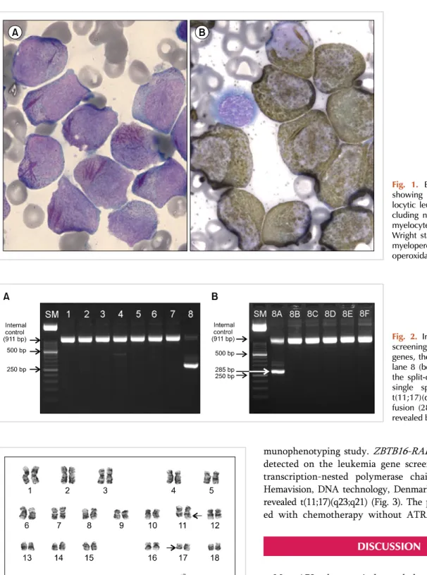Fig. 1. Bone marrow aspirates  showing typical acute  promye-locytic leukemia morphology,  in-cluding numerous leukemic  pro-myelocytes with faggot cells (A)  Wright stain; ×1,000 and strong  myeloperoxidase activity (B)  myel-operoxidase stain; ×1,000).