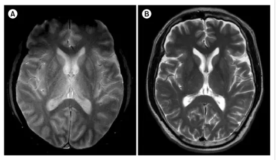 Fig. 1. (A) Increased signal inten- inten-sities in both medial thalami  com-patible with Wernicke’s  encephalo-pathy clearly seen on a T2-weighted gradient-recalled echo image