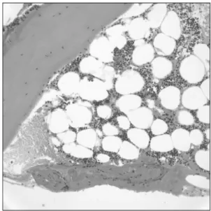 Fig. 2. Bone marrow examination reveals a slight hypo- hypo-cellular marrow with no evidence of neoplastic infiltration