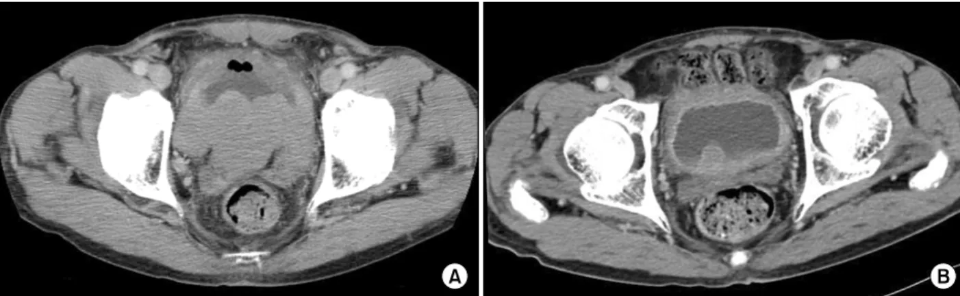 Fig. 1. Abdominal CT scan finding. (A) Marked wall thickening of bladder wall and soft tissue mass around both distal ureter.
