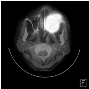 Fig. 2. PET scan showing a focus of hypermetabolism in  the mass of left maxillary sinus area.