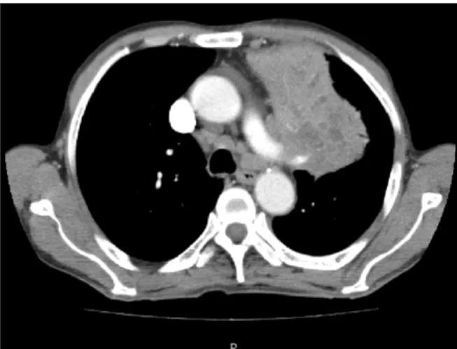 Fig. 3. The chest CT shows that a large mass with multiple nonenhancing areas in the left upper lobe is in contact with left pulmonary artery.
