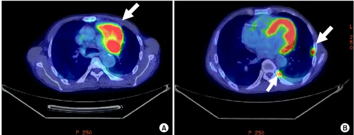 Fig. 4.  In  the  PET  CT,  there  is  an  increased  FDG  uptake  at  the  left  upper  lobe  mass  (SUV=8.8;  arrow)  shown  in  chest  CT (A) and there are multinodular increased FDG activities at left pleura (SUV=5.4 and 4.1, respectively; two arrows) 