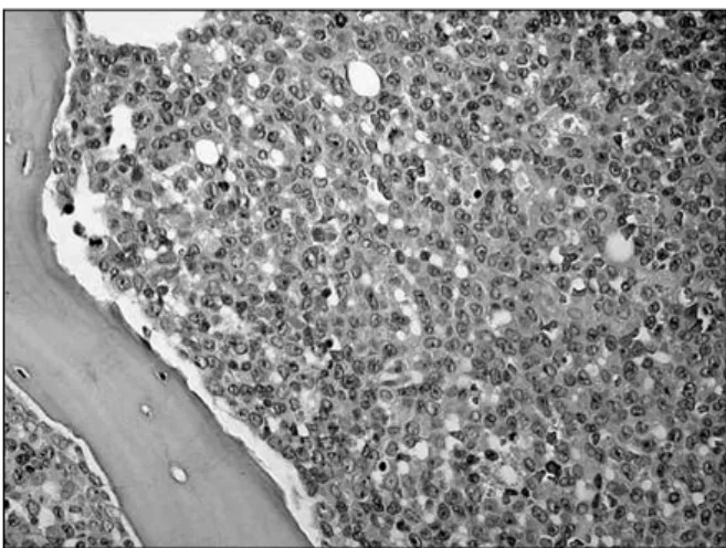 Fig. 1. The bone marrow aspirate shows myeloblastic cells (Wright Giemsa ×1,000).