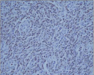 Fig. 2. Immunohistochemistry, showing the cells to be  strongly positive for the T-cell marker CD3 (×400).
