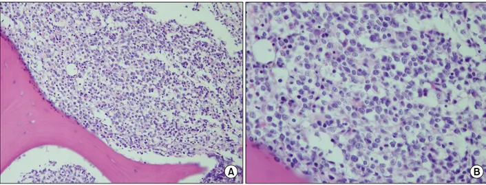 Fig. 1. Histologic features of diffuse large B cell lymphoma in the bone marrow. (A) Atypical large lymphoma cells are diffusely infiltrated (H&amp;E stain, original magnification ×200)