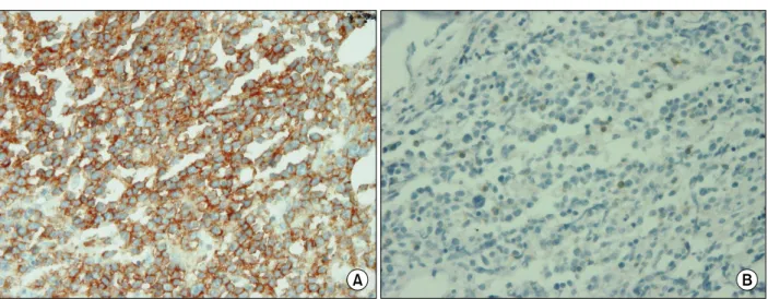 Fig. 2. Immunohistochemical stain of the bone marrow. (A) Lymphoma cells are positive for CD20 (original magnification 