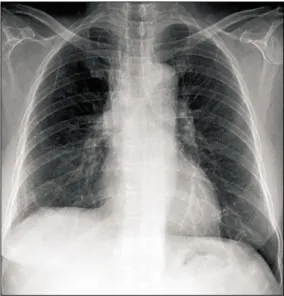 Fig. 2. Lung window of a coronal reformatted CT scan  shows extensive ground-glass opacity in both lungs  except for some areas (arrows)