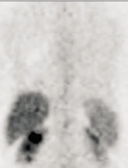 Fig. 4. Small and medium-sized blood vessels of the lung filled with intravascular lymphoma cells