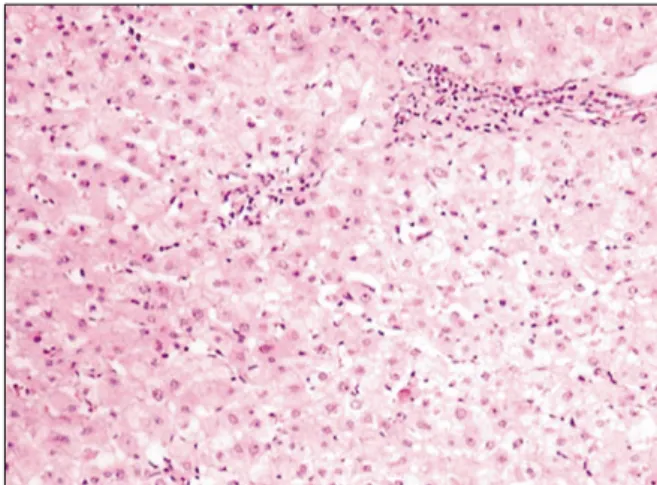 Fig. 1. Liver biopsy (H&amp;E stain, x200).