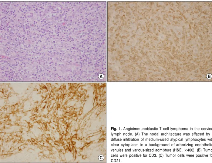 Fig. 1. Angioimmunoblastic T cell lymphoma in the cervical  lymph node. (A) The nodal architecture was effaced by a  diffuse infiltration of medium-sized atypical lymphocytes with  clear cytoplasm in a background of arborizing endothelial  venules and vari
