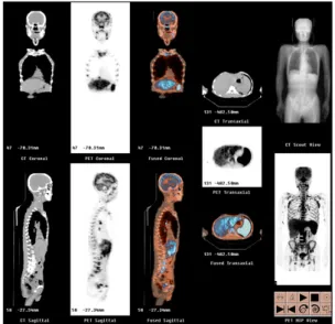 Fig. 1. The increased FDG uptake in the axial skeleton of whole body is noted. The multifocal increase of FDG uptake in multiple lymph node areas including jugular,  para-tracheal, internal mammary, subcarinal, hilar, anterior and  middle diaphragmatic, po