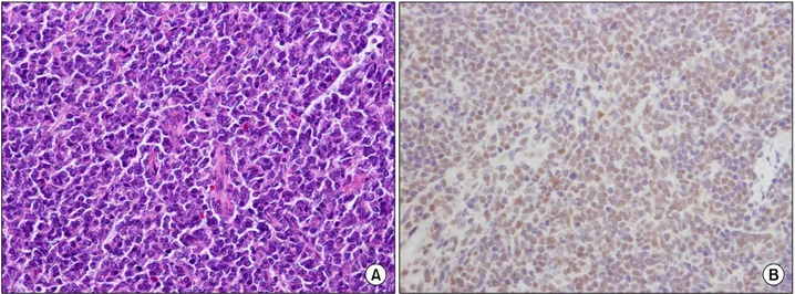 Fig. 2. The microscopic examination of the lymph node from the inguinal area shows diffuse proliferation of small to me- me-dium-sized lymphoid cells with irregular nuclear contour, and admixed lymphoid cells with dispersed chromatin resembling lymphoblast
