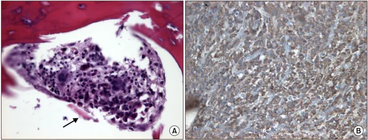 Fig. 2.  Eccentrically  placed  nuclei  of  neoplastic  plasma  cells  with  basophilic  cytoplasm  and  a  sequestrum  (black  arrow)  (Bone biopsy, H&amp;E stain, ×400, A) and positive staining for λ chain (×400, B).