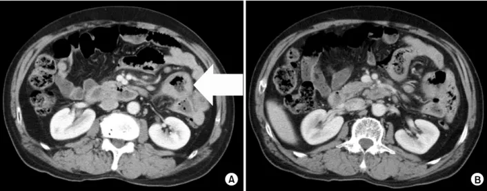 Fig. 1. Postoperative abdominal CT scan finding. (A) The jejunum shows multifocal wall thickening(arrow)