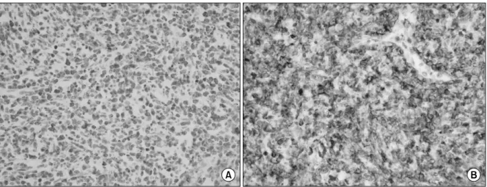 Fig. 3. Immunohistochemical staining shows (A) CD3+ (×400), and (B) CD56+ (×400). 