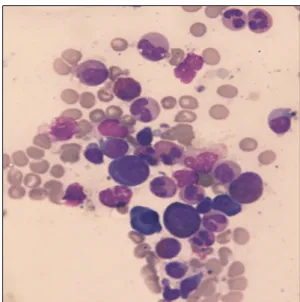 Fig. 1. Bone marrow aspirate smear showing marked de- de-crease of erythroid precursors (Wright-Giemsa stain, ×400).