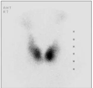 Fig. 2. Radionuclide ( 99m Tc) scan of the thyroid showing  diffuse thyroid enlargement  with irregular contour