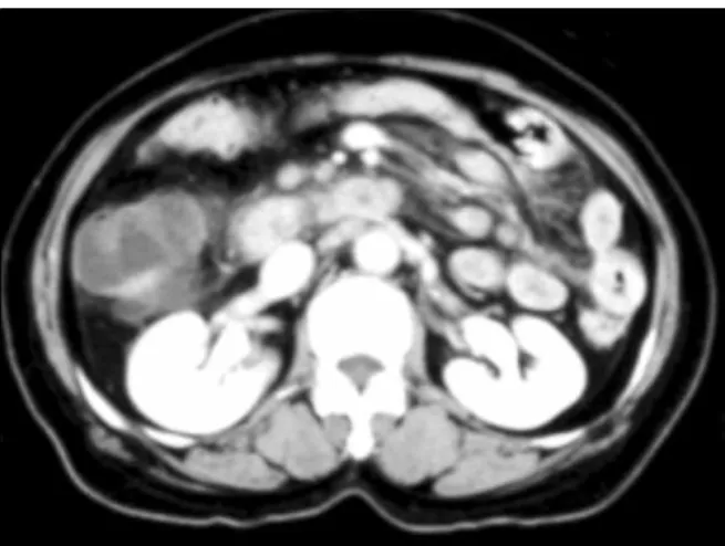 Fig. 1. Cutaneous finding shows multiple palpable purpura on both legs.