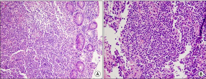 Fig. 6. Pathologic finding of ileocecal area biopsy via colonoscopy shows atypical lymphoid cell proliferation in lamina propria (A: H&amp;E, ×200) and large neoplastic cells with vesicular nuclei (B: H&amp;E, ×400).