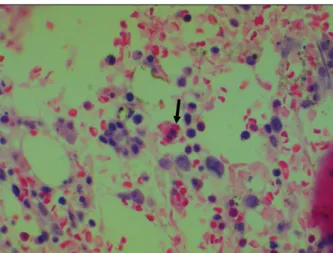 Fig. 1. The bone marrow shows focal infiltration by monot- monot-onous neoplastic cells, which are admixed with  hemopha-gocytic histiocytes (arrow) (H&amp;E stain, ×400).