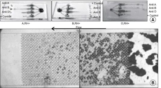 Fig. 3. The blood typing re- re-sults using  Microfluidics-Tech-niques (A) and the filtering  ef-fect of blood typing  micro-chip in +2 agglutination  re-action (B).