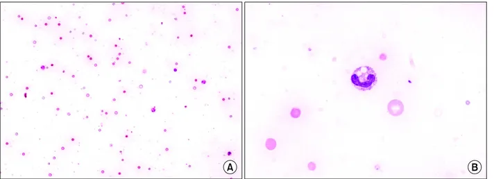 Fig. 2. The peripheral blood smear showed gross intravascular hemolysis with reddish background, a lot of irregular sized  erythrocytes, many spherocytes, ghost erythrocytes, and toxic change in neutrophils with toxic vacuoles [(A) Wright-Giemsa stain, ×20