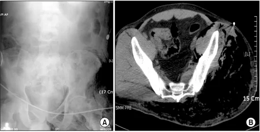 Fig. 3. Simple abdomen supine x-ray showed extensive  sub-cutaneous emphysema on left  side buttock and left inguinal  area  (A)