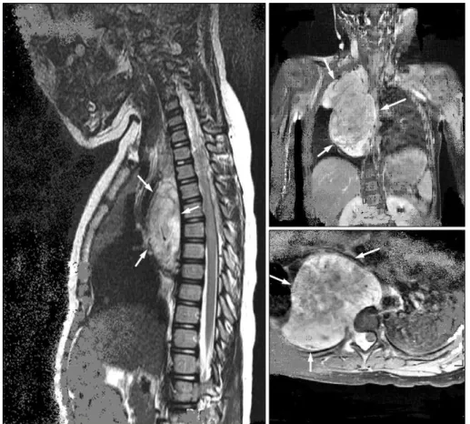 Fig. 1. T-shine MRI shows a  huge paraspinal soft tissue  mass with multiple neural  fora-minal encroachment and  epi-dural involvement in C7 to T5  level (white arrows).