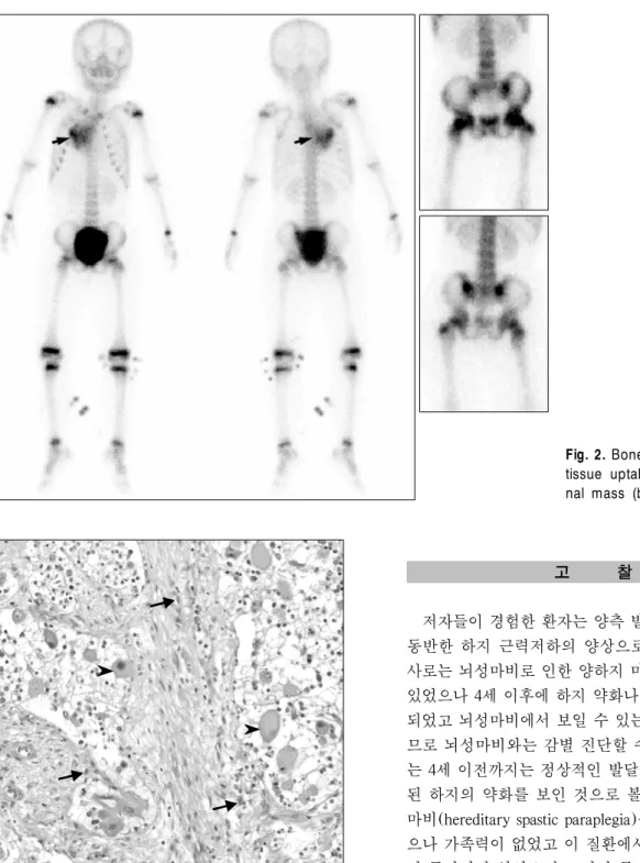 Fig. 2. Bone scan shows a soft  tissue uptake in right  paraspi-nal mass (black arrows).