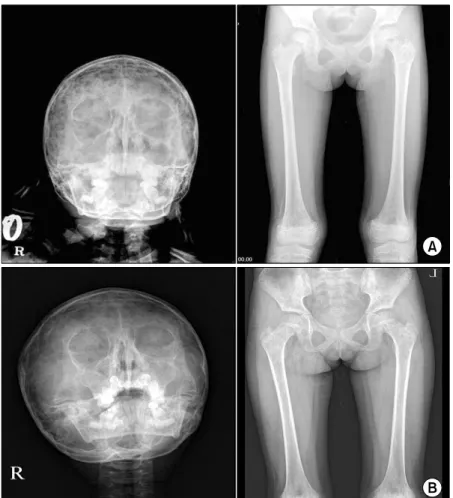 Fig. 3.  Simple  x-ray  and  MR  im- im-age of the left proximal  hume-rus at diagnosis (A) and after  CR (B)