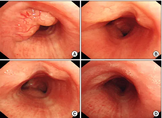 Fig. 1. Serial bronchoscopic findings. (A) At 20cm from upper incisor, multi-lobulated, multi-lobulated tumor with vasculariza- vasculariza-tion was seen