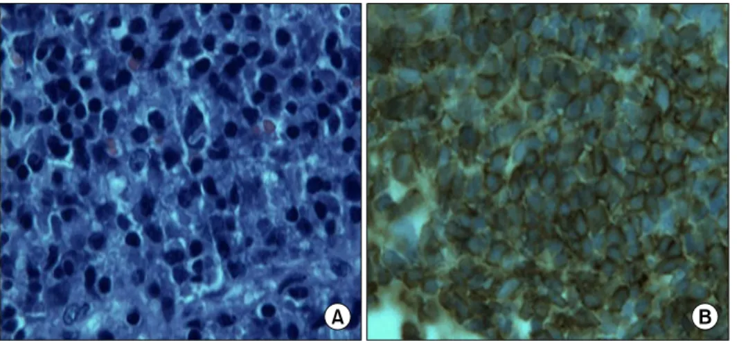 Fig. 2. The chest CT shows a polypoid mass lesion in the Lt anterolateral aspect of the trachea