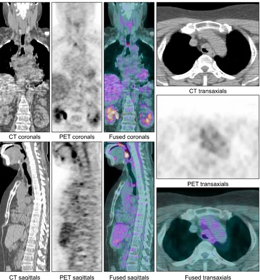 Fig. 4. PET-CT shows a  1.5×1.0cm sized polypoid  mass lesion in trachea. 