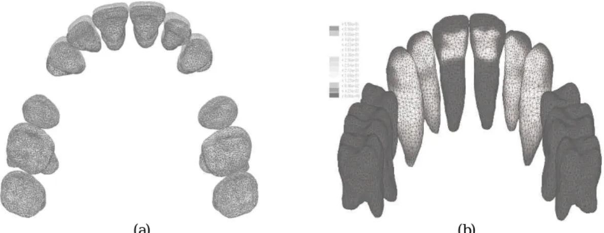 Fig. 6 Analysis result of the CASE IV model for lingual orthodontics: (a) deformed shape (b)distribution of von  Mises stress in teeth