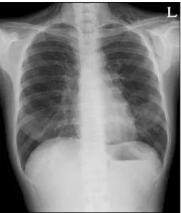 Fig. 1. Plain chest radiograph showing subcutaneous em- em-physema in the neck and upper trunk and  pneumomed-iastinum.