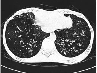 Fig. 3. High resolution CT of the chest showing the recurred subcutaneous emphysema and pneumomediastinum.