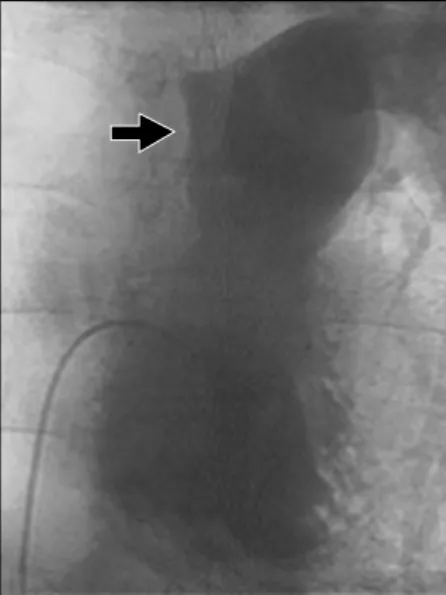 Fig. 1. Pulmonary angiogram shows filling defect in right pulmonary artery.다. 15년간 소주 2～3병씩 주 3～4회 마셔왔고 15갑년의 흡연력을 가지고 있었다