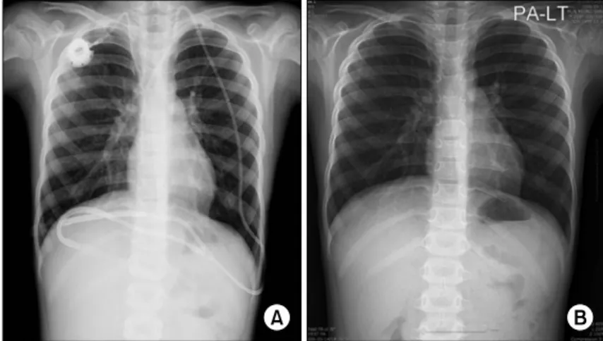 Fig. 1. Chest PA. (A) Chest PA at the time of  diagnosis showed no definite abnormality