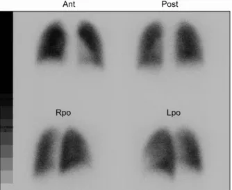 Fig. 3. Lung perfusion scan. Perfusion defect was not  seen before the thrombolytic therapy.
