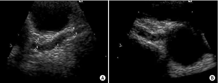 Fig. 4. Echocardiogram revealed normal left ventricular size and contractility without any regional wall motion abnormalities.