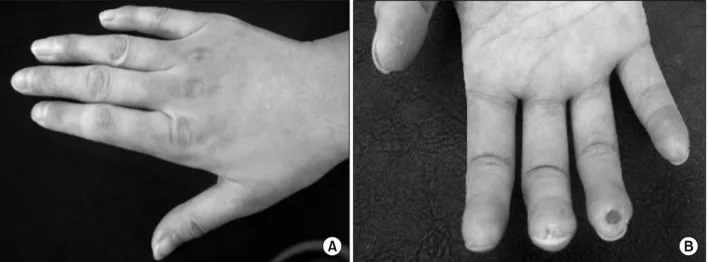Fig. 2. (A) The hands show tightening of the skin. (B) Ulcers appear on the fingertips
