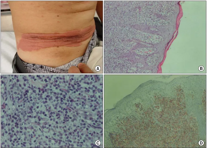 Fig. 1. (A) Photography of skin lesion. (B), (C) and (D) Dense band-like infiltration of sm all sized atypical lym phocytes with  slightly irregular nuclear contour in papillary derm is and perivascular space (B: H-E stain, × 100, C: H-E stain, × 400, D: 