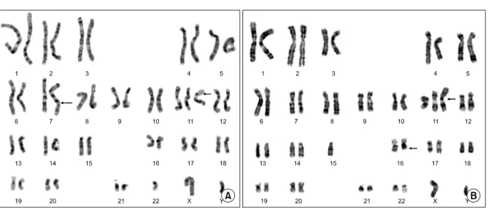 Fig. 3. Cytogenetic analysis with bone m arrow shows diverse chrom osom al abnorm alities