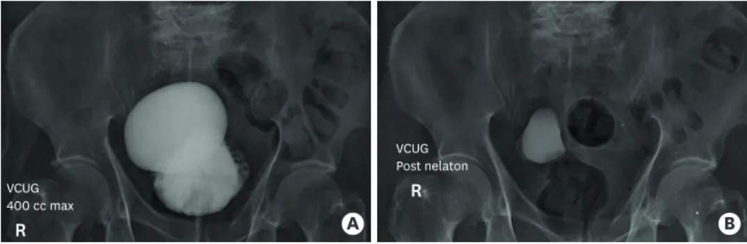 Fig. 1. The VCUG test show the bladder diverticulum (A) and a residual urine after voiding phase in the bladder  diverticulum (B) before surgery
